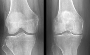 USDA vitamina d osteoartritis